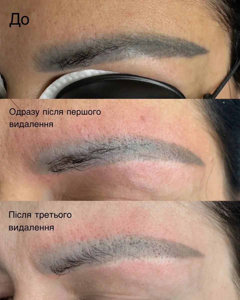 Лазерне видалення · портфоліо